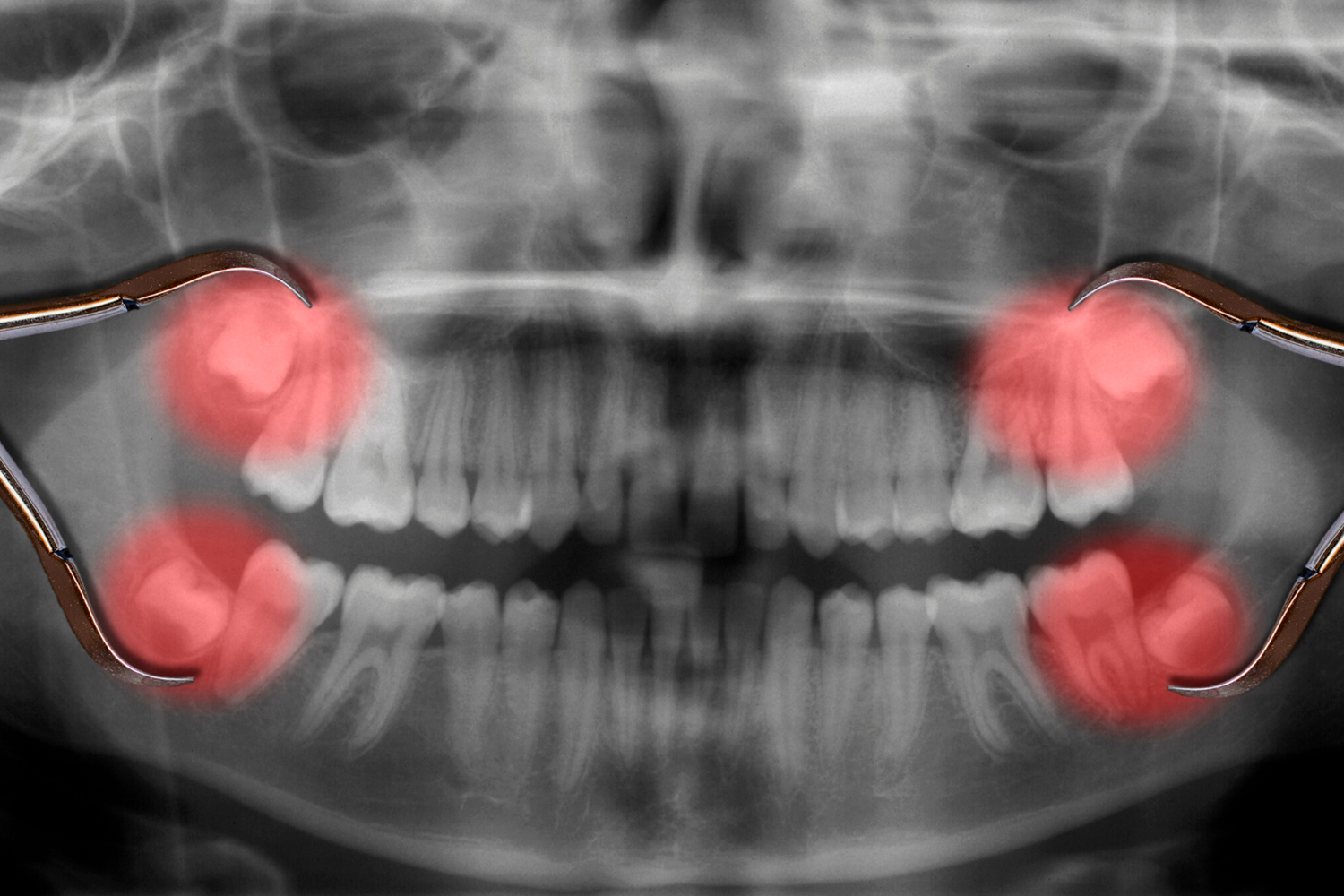 Cirugía Oral - Custom Dental