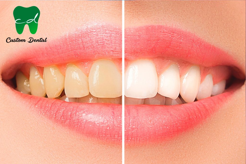 El Blanqueamiento Dental mejora la sonrisa