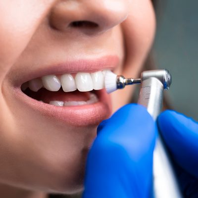 Limpieza dental profesional