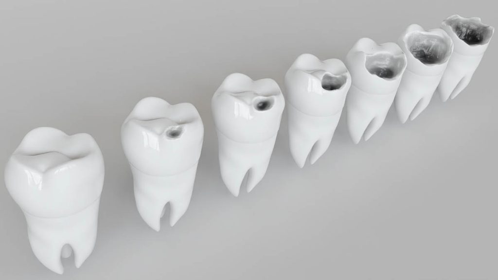 etapas de la caries dental