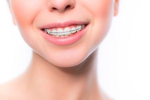 La Ortodoncia para mejorar tu sonrisa