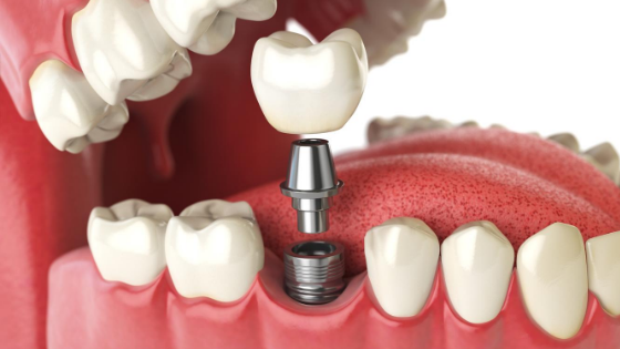 implante dental 