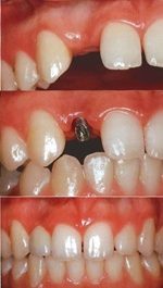 Implante dental para un diente