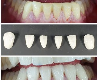 Carillas o laminados dentales de porcelana