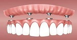Implantes dentales en bocas sin dientes