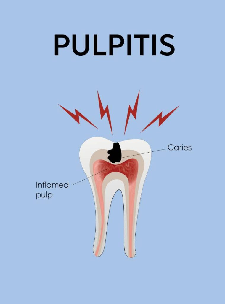 Pulpitis dental