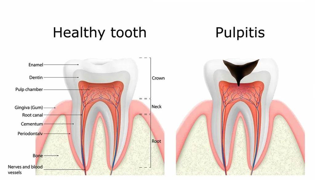 Molar sano y molar con pulpitis