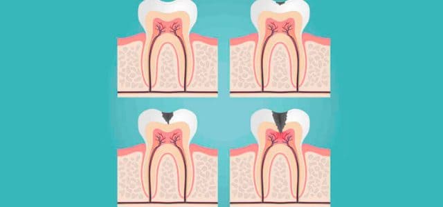 Pulpitis irreversible