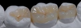 Incrustaciones dentales, una alternativa mínimamente invasiva