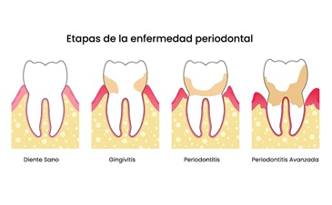etapas enfermedad periodontal
