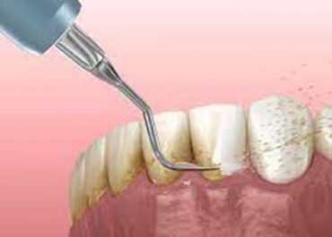 La enfermedad periodontal