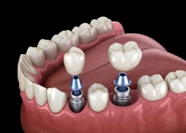 Ventajas de los Implantes Dentales