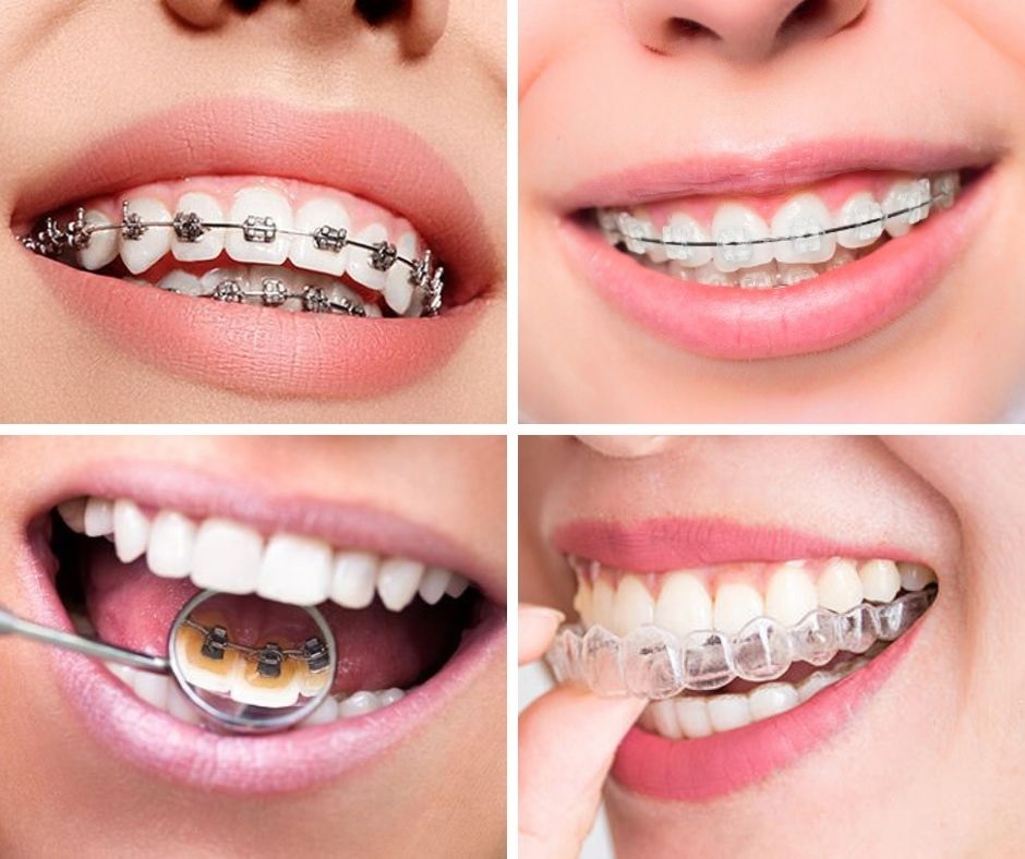 Tipos de ortodoncia 