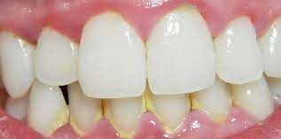Se muestra unos dientes con sarro y con encía inflamada