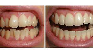 El antes y el después con Ortodoncia Invisible