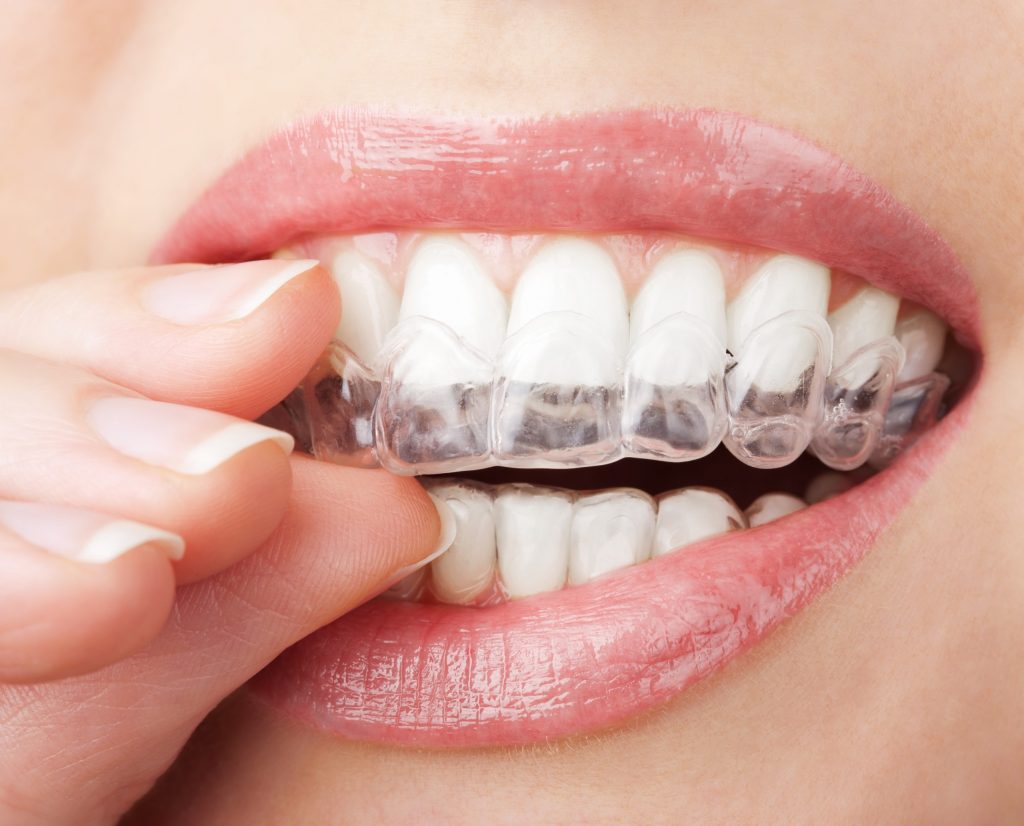 Alineadores Dentales para Ortodoncia Invisible.