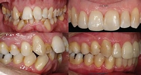 Corrección Dental con Ortodoncia Invisible