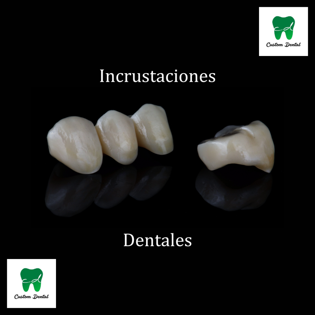 Distintas formas y tamaños de las incrustaciones dentales.