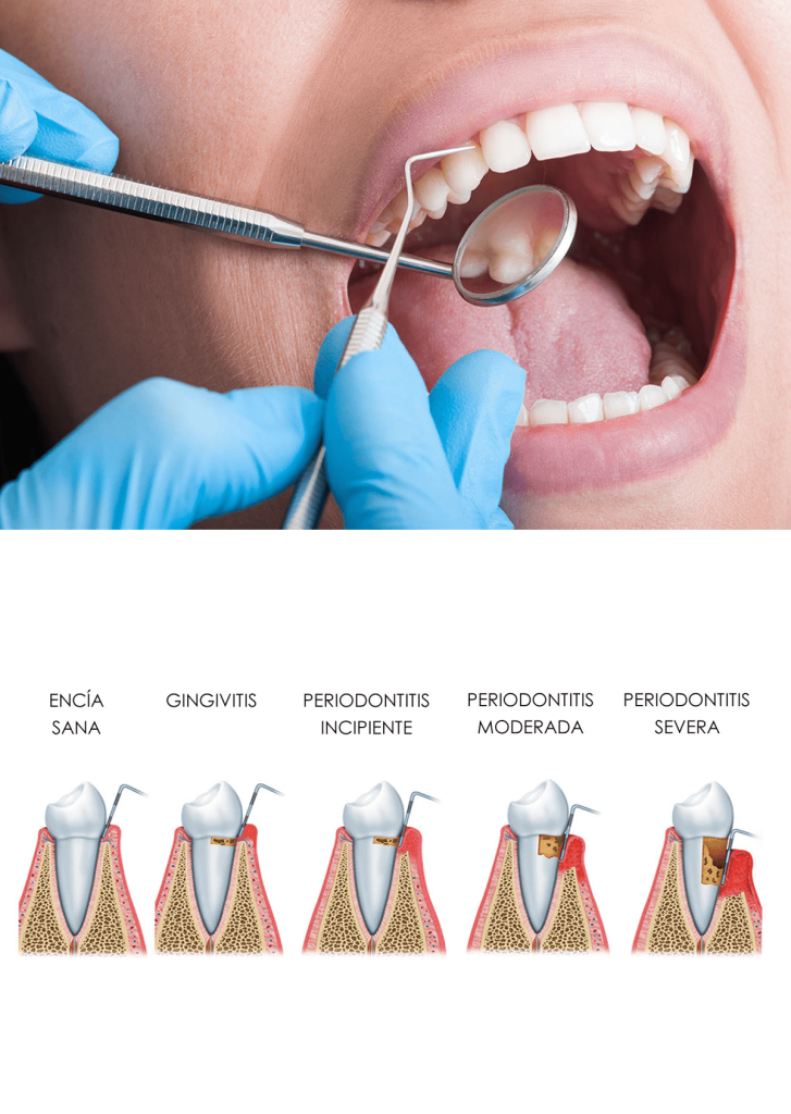 Cirugía periodontal Cuando hacerla