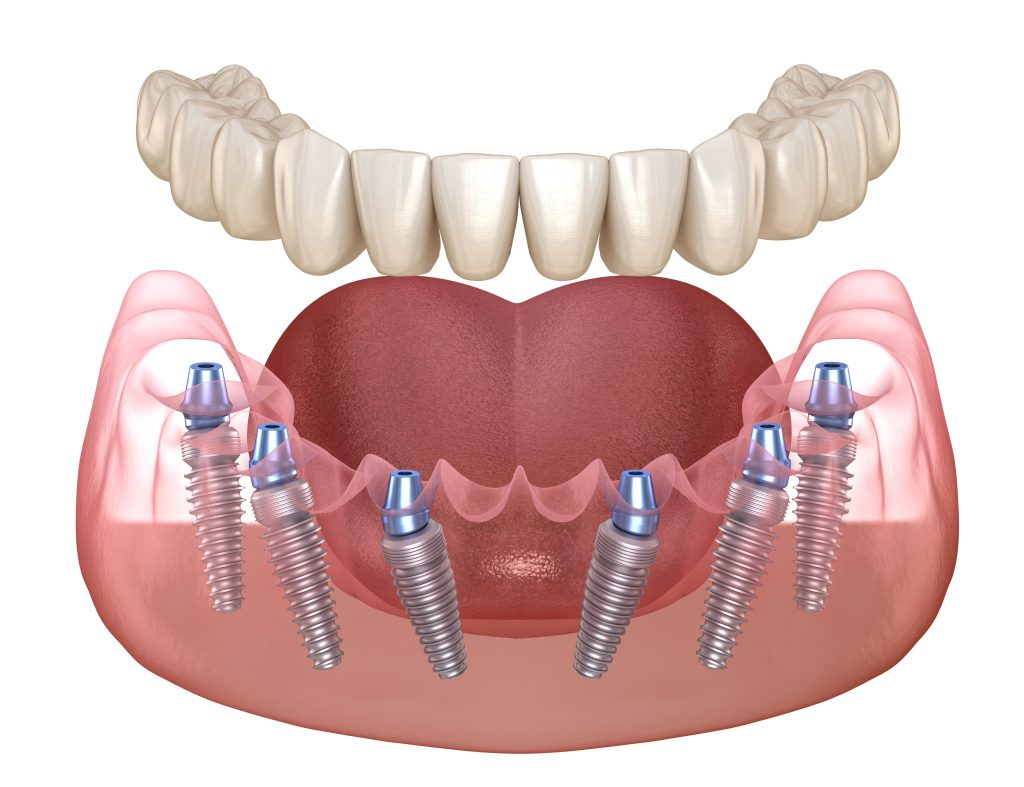 Implantes dentales para una boca sin dientes.
