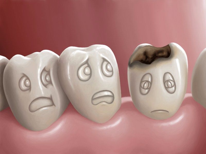 Caries dental 