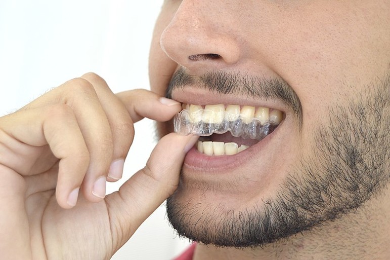 10 Ventajas de la ortodoncia Invisible