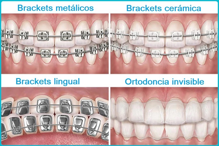 Distintos tipos de Ortodoncia.