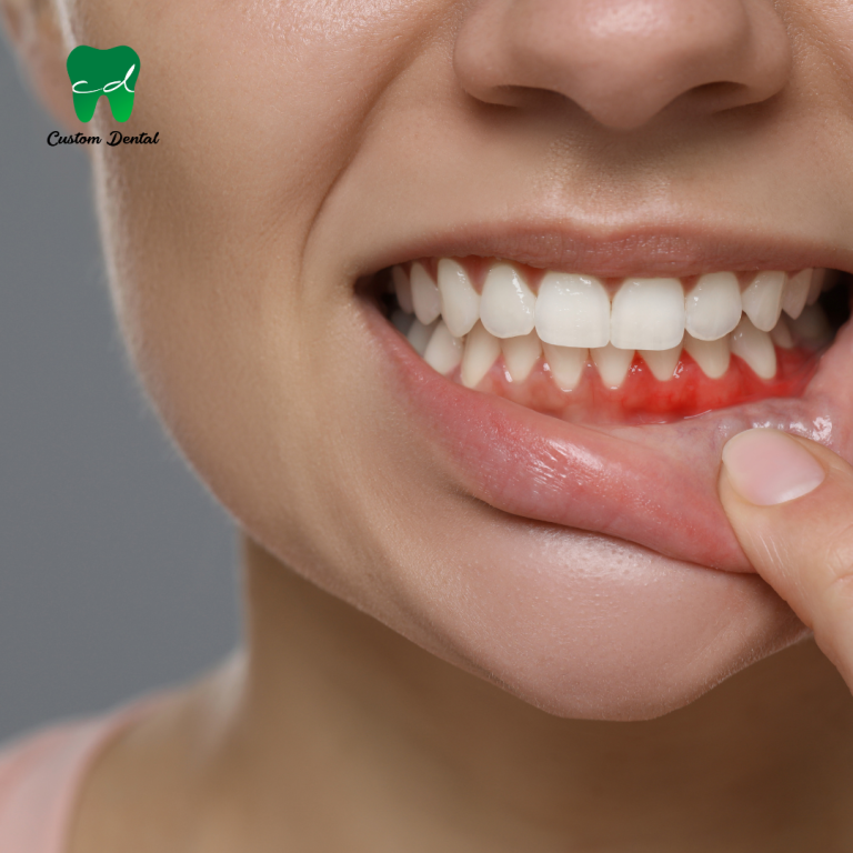 ¿Te sangran las encías? En Custom Dental nos ocupamos de la salud de tus encías