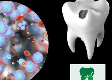 La Evolución de la Caries: Prevención y Avances en la Odontología