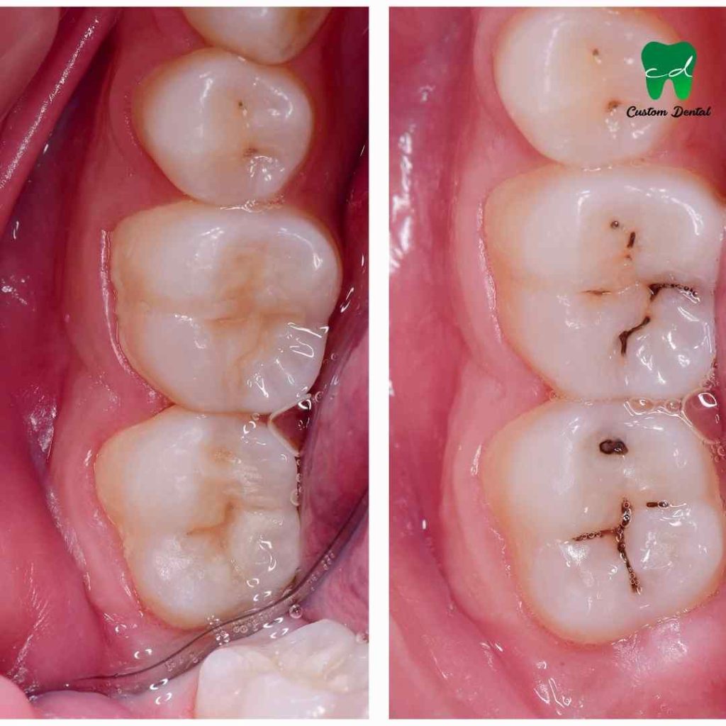La caries dental es una enfermedad que va más allá de los dientes.