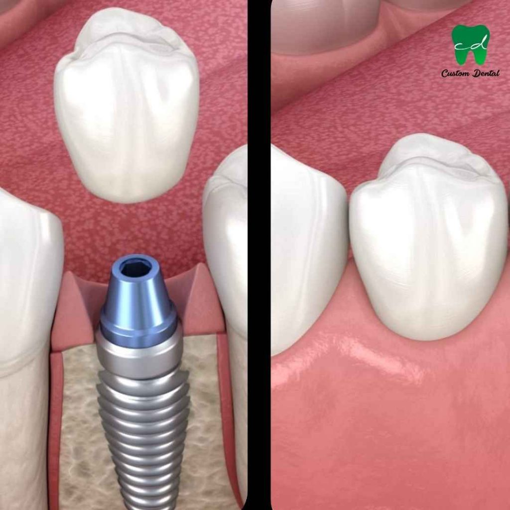 Los Implantes Dentales en Custom Dental