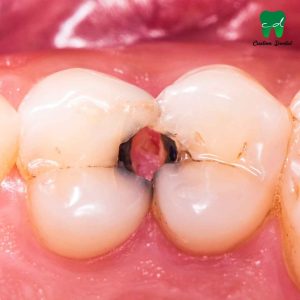 La caries Dental se puede prevenir. Realiza tu revisión dental.