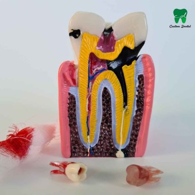 Pulpitis dental