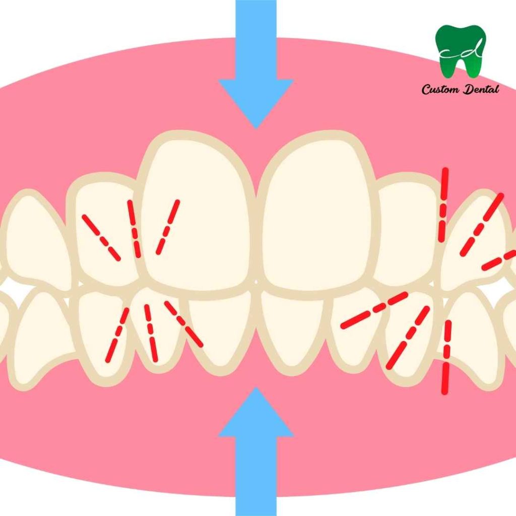 Mala posición dental