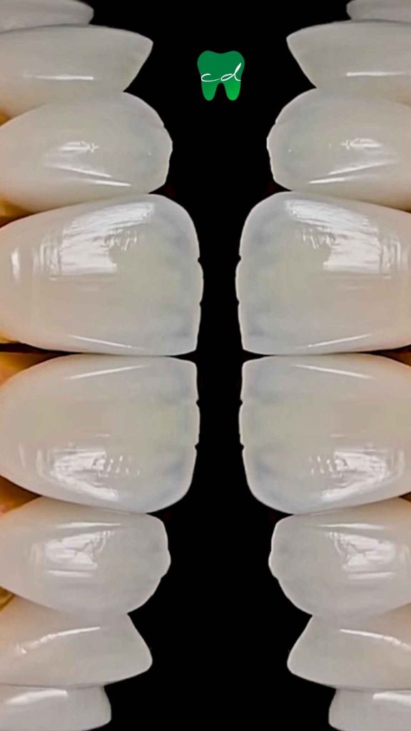 Carillas Dentales y Diseño de Sonrisa.