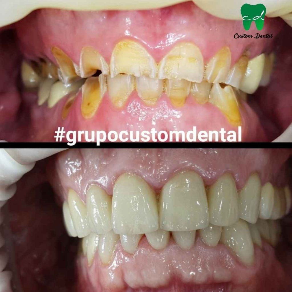 Rehabilitación con carillas dentales de porcelana en desgastes severos de los dientes.