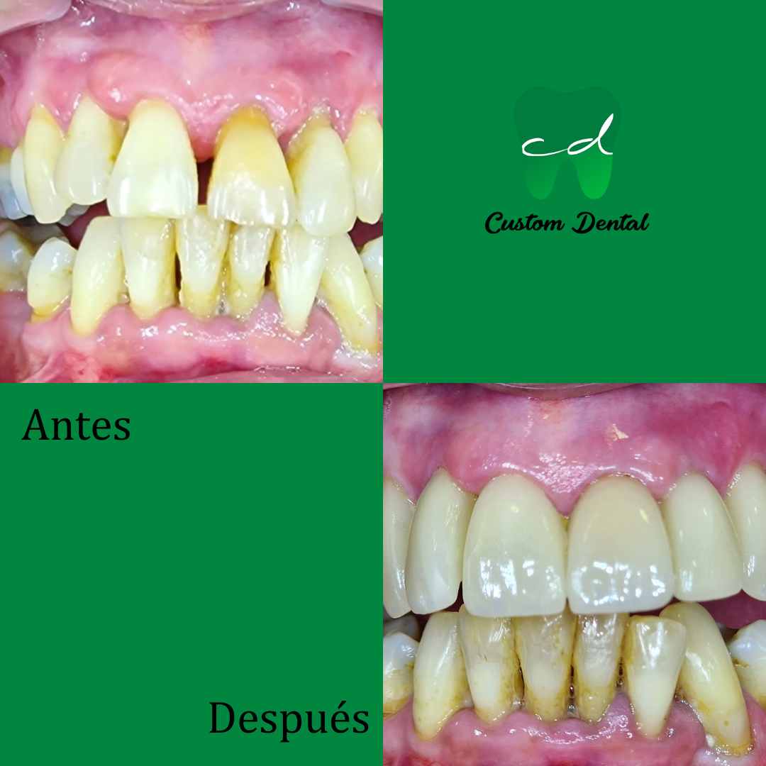 Remodelado de encía y rehabilitación dental
