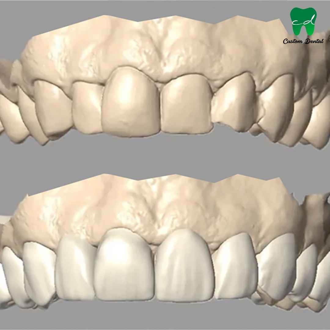 Diseño digital de sonrisa.