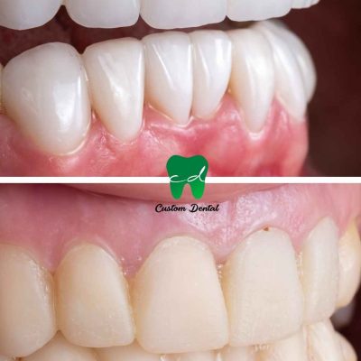 Carillas Dentales de Porcelana y Diseño de la Sonrisa