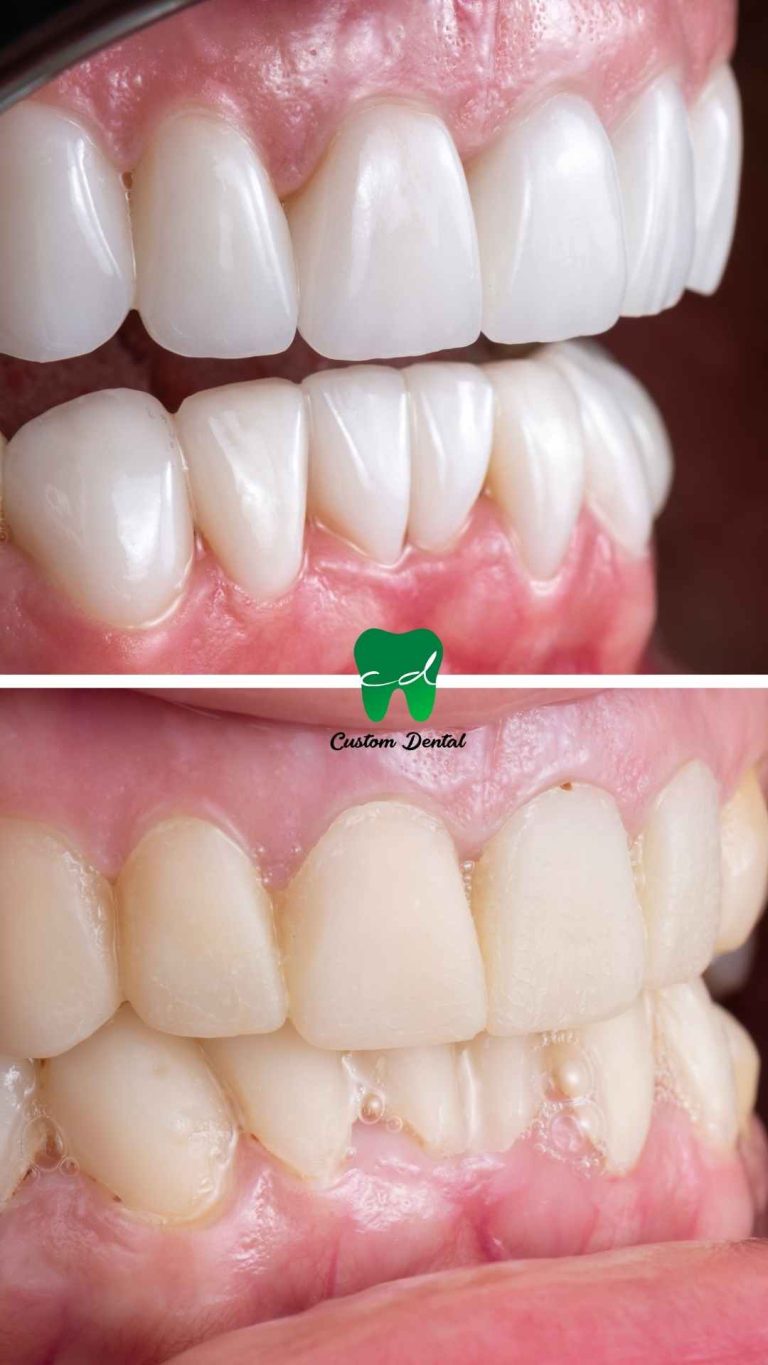 Carillas Dentales de Porcelana y Diseño de la Sonrisa