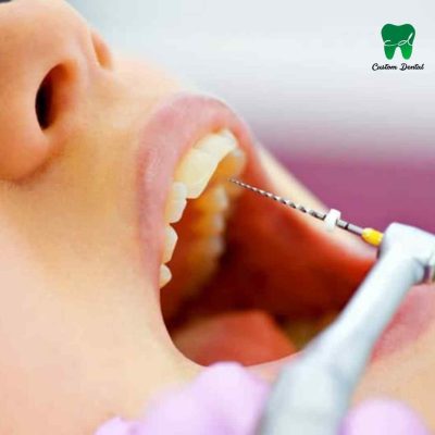 Endodoncia con instrumental rotatorio