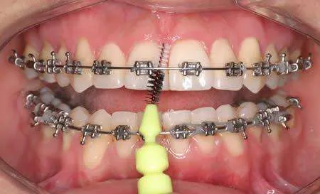 Cepillos interproximales o interdentales para higiene en ortodoncia