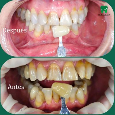 Blanqueamiento Dental para rejuvenecer y mejorar tu sonrisa.