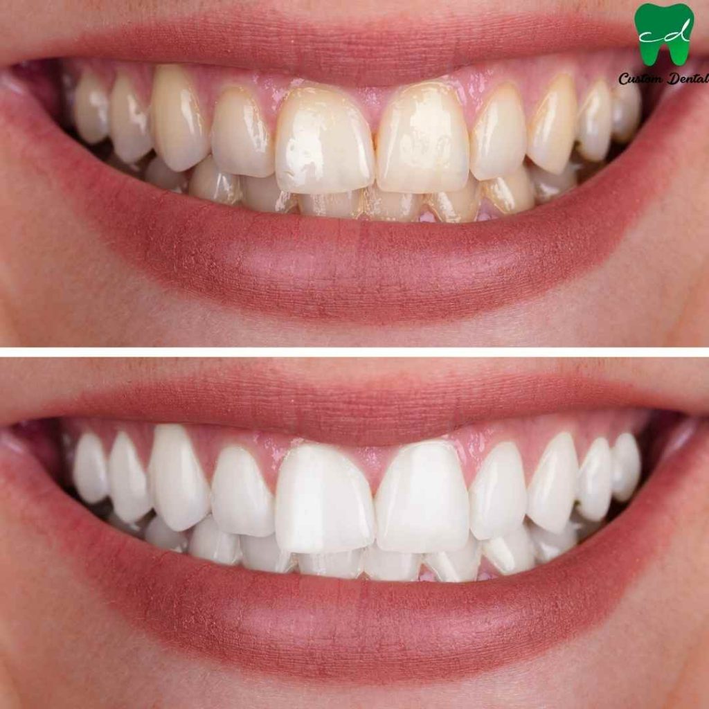 Blanqueamiento Dental