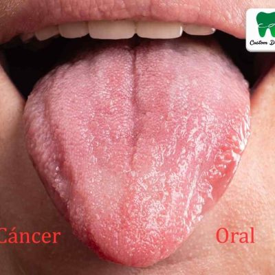 cáncer oral. Evita las drogas, evita el cáncer oral
