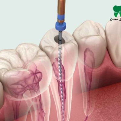 La endodoncia salva tus dientes.