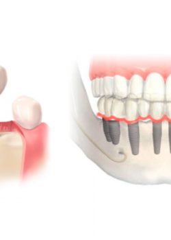 Implantes dentales TEMP